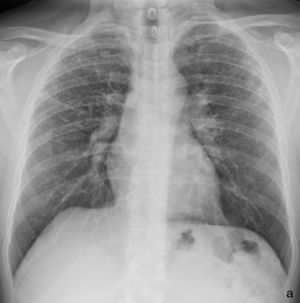 Radiografía torácica del caso clínico 2 (año 2013).