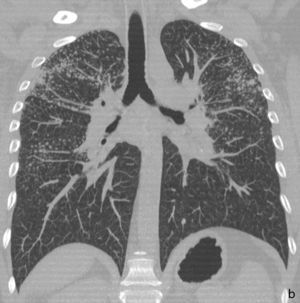 TAC con reconstrucción multiplanar en plano coronal del caso clínico 2.