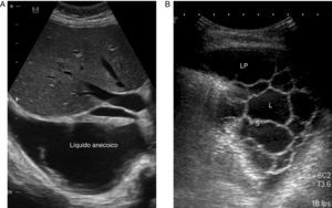 A)Derrame pleural anecoico. B)Derrame pleural con múltiples septos y loculaciones. L: loculación; LP: líquido pleural; S: septo.