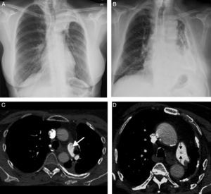 A) Radiografía de tórax posteroanterior de una paciente de 52 años (paciente X de aquí en adelante) con antecedente de carcinoma broncogénico tratado con quimioterapia y radioterapia 7 años antes, en la que se observa una atelectasia completa del LSI. B) Radiografía de tórax posteroanterior de un paciente de 85 años (paciente Y de aquí en adelante) en la que se observa una extensa paquipleuritis izquierda calcificada y una importante pérdida de volumen del hemitórax ipsilateral. C) Imagen axial de TC de la paciente X en la que se identifica un defecto de repleción aparente en la arteria pulmonar principal izquierda (flecha), que se interpretó erróneamente como un TEP. D) Imagen axial de TC del paciente Y en la que se observa otro defecto de repleción aparente en la arteria pulmonar principal izquierda (flechas), que también se interpretó equivocadamente como un TEP.