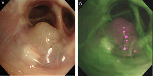 Imágenes de broncoscopia: (A) Masa bronquial en la entrada de B2 en el pulmón derecho (B) imagen de broncoscopia de autofluorescencia que muestra una fluorescencia relativamente menor que la del tejido normal.