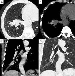 TC torácica de alta resolución donde se aprecia el taponamiento mucoso de los bronquios dilatados (A, ventana pulmonar) y lesiones de alta atenuación (B, ventana mediastínica) en el lóbulo inferior derecho. En la vista coronal de la TC con contraste intravenoso se detectaron parcialmente tapones mucosos de alta atenuación (C). La TC de seguimiento mostró mejoría del taponamiento mucoso y presencia de bronquiectasia (D).