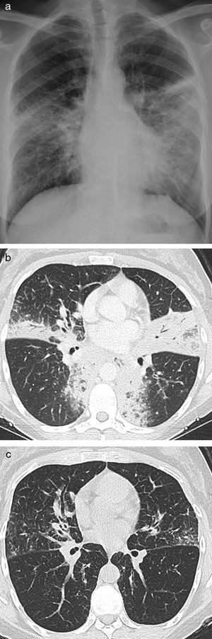 a) Radiografía de tórax y b) tomografía computarizada del caso 1 en el momento del diagnóstico. c) Tomografía computarizada de tórax del caso 1 transcurridos 18 meses desde el diagnóstico.