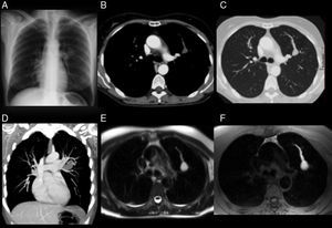 A) Radiografía PA de tórax. B y C) TC de tórax con contraste intravenoso, corte axial a nivel de la ventana aortopulmonar en ventana de mediastino y de pulmón, respectivamente. D) TCMD reconstrucción coronal en máxima intensidad de proyección (MIP) ventana de mediastino. E y F) RM de tórax, cortes axiales a nivel de la ventana aortopulmonar. Cortes axiales potenciados en T2 y T1 con supresión grasa.