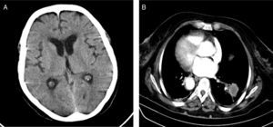 A) TAC cerebral que no muestra lesiones intracraneales. B) TAC torácica que muestra una masa lobulada de 3cm en el lóbulo inferior derecho.