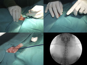 Implantación percutánea de un stent guiada con fluoroscopia.