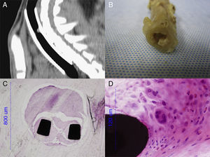 Imágenes de una sospecha de granuloma. A) Imagen de TAC, proyección sagital con aspecto de granuloma. B) Visión macroscópica de un granuloma. C) Visión microscópica (10 aumentos) de un granuloma alrededor de la estructura del stent. D) Visión microscópica (60 aumentos) de una célula gigante.