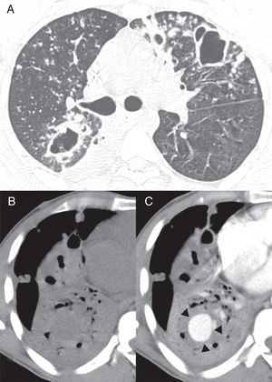 A) Imagen de tomografía computarizada (TC) axial a nivel de la bifurcación bronquial obtenida con configuración en ventana de pulmón. Muestra múltiples nódulos bilaterales y cavidades en el parénquima pulmonar. Imágenes de TC en ventana mediastinal a nivel de los lóbulos inferiores, antes (B) y después (C) de la administración de contraste muestran una consolidación en el lóbulo inferior derecho con una lesión redonda, con captación dentro del área consolidada (flechas).