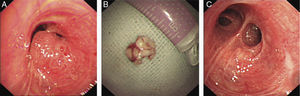 Imagen por broncoscopia de un tumor rosa, moruloide y muy vascularizado (A), masa dura resecada similar con apariencia de palomitas de maíz (B), bronquio superior izquierdo desobstruido y mucosa bronquial normal en el lecho quirúrgico (C).