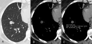 Imágenes por TAC en ventana pulmonar (A) y mediastínica (B), que muestran un nódulo hipodenso bien definido de 13mm de diámetro en el lóbulo inferior derecho. La densidad del nódulo corresponde a la de una grasa (densidad media: −41 HU) (C).