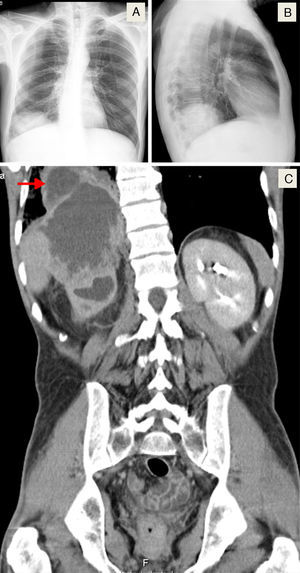 A y B) Imágenes radiológicas torácicas (posteroanterior y lateral, respectivamente) que revelan una opacidad redondeada en la base del pulmón derecho. C) TAC toracoabdominal (plano coronal) que muestra una gran masa abdominal de unos 13×11×8,3cm, aparentemente originada en el riñón derecho, que invade el lóbulo hepático derecho, el diafragma y el lóbulo inferior del pulmón derecho (ver la flecha en el campo superior izquierdo).
