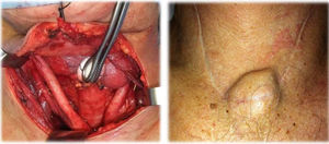 Campo quirúrgico y metástasis incisional de 1,8×1,4cm en la cicatriz del TEMLA.