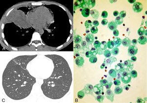 A) Tomografía computarizada en ventana mediastínica que muestra una masa en el lóbulo inferior derecho junto a la superficie pleural. B) Macrófagos alveolares del lavado broncoalveolar. El citoplasma presenta grandes vacuolas redondeadas que desplazan los núcleos a la periferia. C) Tomografía computarizada de seguimiento en ventana pulmonar que mostró reabsorción de la masa con cicatriz residual.
