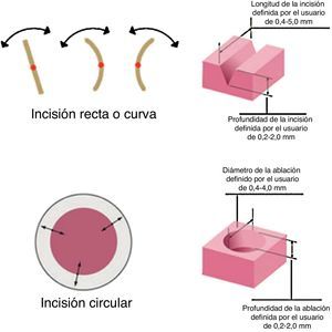 El láser AcuBlade® permitió realizar diferentes tipos de incisiones (recta, curva o ablación en disco), con la longitud y la profundidad deseadas según la forma de la lesión.
