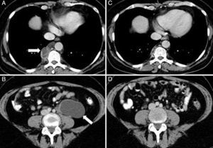 Tomografía axial computarizada (TAC) torácica (A) donde se observa una lesión quística paravertebral derecha de 3,2×1,9cm, compatible con un linfangioleiomioma retrocrural. TAC abdominal (B) donde se aprecia una tumoración de 6,8×3,9×5,1cm de aspecto quístico retroperitoneal, de localización paraaórtica izquierda que se extiende hasta la pelvis, compatible con un linfangioleiomioma abdominal. TAC toraco-abdominal al año (C y D) donde se observa una resolución prácticamente completa de las lesiones descritas.