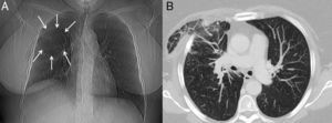A) Radiografía de tórax en la que se observa un área radiolucente de morfología redondeada en campo pulmonar superior derecho (flechas). B) Imagen axial de TC de tórax (ventana de parénquima pulmonar) en la que se observan áreas de atenuación en vidrio deslustrado y un engrosamiento del intersticio en el parénquima pulmonar herniado, compatibles con zonas de congestión venosa y edema.