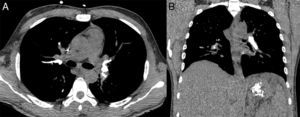 Imágenes axial (A) y coronal (B) de la tomografía computarizada que muestran múltiples émbolos hiperdensos en las arterias pulmonares. En la imagen B también se observan émbolos similares en el fondo gástrico.