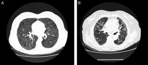 Radiología de la enfermedad del pulmón de granjero. A. TCAR torácica de paciente con EPG aguda. Se aprecian infiltrados en vidrio deslustrado y nódulos centroacinares. B. TCAR torácica de paciente con EPG crónica. Destaca un patrón reticular en campos medios con presencia, en menor grado, de vidrio deslustrado.