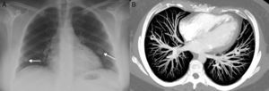 A) Radiografía de tórax en la que se observan 2 nódulos pulmonares (flechas). B) Reconstrucción, proyección de máxima intensidad axial de TC, que confirma la presencia de las MAV pulmonares (asteriscos).