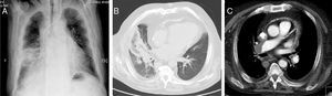 A) Radiografía de tórax que muestra una opacidad nodular irregular en la región perihiliar derecha. B) TAC torácica que muestra el signo del halo invertido. C) Angiografia pulmonar mediante TAC mostrando la presencia de un trombo en la arteria pulmonar principal derecha.