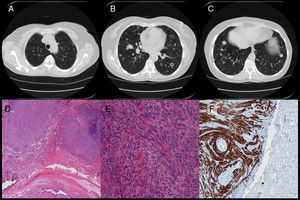 A-C) TAC torácica del LBM. D y E) Anatomía patológica de la biopsia pulmonar del LBM. F) Estudio inmunohistoquímico de desmina en la biopsia pulmonar del LBM.