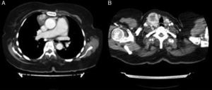 Tomografía axial computarizada en la que se evidencia masa mediastínica hipervascular de 3,6×2,7cm de localización paracardíaca derecha (A), y bocio multinodular a expensas de lóbulo tiroideo derecho (B).
