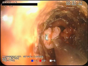 Punta del microdebridador resecando un granuloma en el extremo distal de la prótesis metálica.