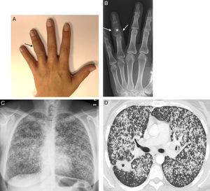 A) Tumoración (flecha) dolorosa que afecta a la falange media del cuarto dedo de la mano izquierda. B) Radiografía de la mano izquierda en la que se observa una lesión lítica en la falange media del cuarto dedo (asterisco), que se acompaña de un aumento de partes blandas (flechas). C) Radiografía de tórax en la que se visualiza una llamativa afectación nodular bilateral. D) Imagen axial de TC (ventana de pulmón) en la que se identifica una masa dominante espiculada en pulmón derecho (asterisco), que se acompaña de múltiples nódulos pulmonares bilaterales de pequeño tamaño).