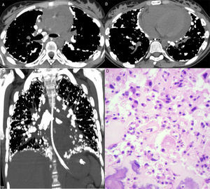 Imágenes de la tomografía axial computarizada a nivel de la bifurcación bronquial (A) y los lóbulos inferiores (B), e imagen coronal reformateada (C) que muestran varios nódulos calcificados en las regiones subpleurales y a lo largo de las fisuras. También se observan calcificaciones en los ganglios linfáticos mediastínicos y derrame pericárdico. D) Sección histológica que muestra la proliferación de células neoplásicas con formación de tejido óseo. También se observan atipias nucleares (hipercromasia y cariomegalia); (tinción de hematoxilina y eosina, ×400).
