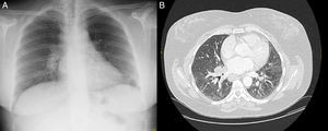 A) Radiografía de tórax que muestra hilio pulmonar derecho prominente, de morfología nodular. B) TC torácica que muestra adenopatías hiliares bilaterales e infiltrados en vidrio deslustrado.