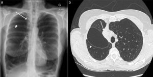 Cavidad aérea interlobular prolongada (flecha corta) y atelectasia del lóbulo superior derecho (flecha larga), tras la implantación de válvulas endobronquiales; a) radiografía de tórax y b) TC de tórax.
