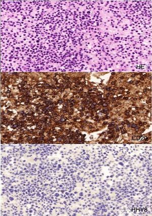 Inmunotinción con hematoxilina-eosina de células del linfoma (HE), con presencia de células CD20 positivas (CD20) y ausencia de HHV-8 (HHV8).