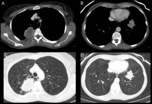 A y C) Cortes axiales de TC en ventana de mediastino y de pulmón respectivamente. Observamos una masa sólida de 6×4cm de bordes infiltrativos, con necrosis en su interior y realce periférico en segmento posterior del LSD adyacente a pleura posterior. B y D) Cortes axiales de TC en ventana de mediastino y de pulmón. Apreciamos otra lesión sólida en el LII adyacente a pleura diafragmática, de contornos infiltrativos, con menor necrosis. E y F) Cortes axiales de TC en ventana de pulmón, a los 6 meses del inicio del tratamiento con bevacizumab. En E vemos la lesión del LSD de mayor tamaño, cavitada y sin componente sólido, y en F la tumoración sólida del LII de menor tamaño y atenuación que en -B y -D).