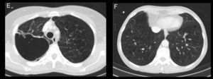 A y C) Cortes axiales de TC en ventana de mediastino y de pulmón respectivamente. Observamos una masa sólida de 6×4cm de bordes infiltrativos, con necrosis en su interior y realce periférico en segmento posterior del LSD adyacente a pleura posterior. B y D) Cortes axiales de TC en ventana de mediastino y de pulmón. Apreciamos otra lesión sólida en el LII adyacente a pleura diafragmática, de contornos infiltrativos, con menor necrosis. E y F) Cortes axiales de TC en ventana de pulmón, a los 6 meses del inicio del tratamiento con bevacizumab. En E vemos la lesión del LSD de mayor tamaño, cavitada y sin componente sólido, y en F la tumoración sólida del LII de menor tamaño y atenuación que en -B y -D).