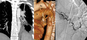 A) Reconstrucción MIP (proyección de intensidad máxima) coronal de TC en la que se identifica una comunicación entre ramas tortuosas de la arteria bronquial izquierda (flechas negras) y una rama segmentaria filiforme (flechas blancas) de la arteria del lóbulo inferior izquierdo. Nótense las secuelas por tuberculosis del hemitórax izquierdo. B) Reconstrucción 3D (volume rendering) de TC de tórax (Ao: aorta; P: arteria pulmonar) en la que se aprecia mejor la fístula entre ramas de la arteria bronquial izquierda (flechas negras) y la arteria pulmonar (flechas blancas). C) Arteriografía en la que se visualiza el llenado retrógrado de las arterias pulmonares (flechas blancas) desde las ramas tortuosas de la arteria bronquial izquierda (flechas negras).