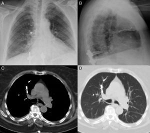 Radiografía de tórax posteroanterior (A) y lateral (B) con material denso ramificado, en relación con émbolos de cemento, en campo pulmonar superior, medio e inferior derechos, y en campo medio izquierdo. En el corte transversal de la TC torácica (C y D), el mismo material ocupa arterias segmentarias del lóbulo superior derecho.