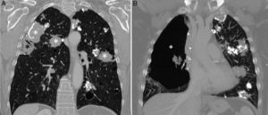 A) Reconstrucción coronal de la TC de tórax (ventana de parénquima pulmonar) en la que se observan múltiples nódulos en ambos pulmones (asteriscos blancos). Obsérvese una lesión cavitada subpleural en pulmón derecho (asterisco negro). B) Reconstrucción coronal de la TC de tórax (ventana de parénquima pulmonar, plano más anterior que la imagen A) que muestra un neumotórax loculado anterior en hemitórax derecho (asterisco).