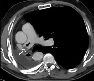 Corte axial de tomografía computarizada multidetector tras contraste intravenoso en fase arterial, en paciente con antecedente de neumonectomía derecha. Se observa defecto de repleción compatible con trombosis del muñón arterial (flecha negra) y también se aprecian las suturas asociadas a la misma (flecha blanca).