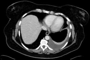 Imagen de la TAC, donde se observa derrame pleural, sin signos de engrosamiento pleural.