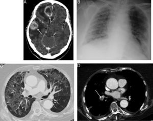 A) Imagen axial de la TC de cráneo, tras la administración de contraste intravenoso, en la que se observan 2 lesiones intraaxiales con realce en anillo (flechas), en hemisferio cerebral izquierdo, con importante efecto de masa y edema perilesional asociado. B) Radiografía anteroposterior de tórax, en la que se identifican opacidades de atenuación en vidrio deslustrado en ambos pulmones. C) Imagen axial de la TC de tórax (ventana de pulmón), en la que se visualiza un llamativo patrón en mosaico del parénquima pulmonar, alternándose áreas de atenuación en vidrio deslustrado con otras de menor densidad, típico de la infección por Pneumocystis jirovecii. D) Imagen axial de la TC de tórax (ventana de mediastino), con contraste intravenoso (obtenida al mismo nivel que la imagen C), en la que se demuestra un defecto de repleción central en la arteria lobar inferior derecha (flecha), en relación con un tromboembolismo pulmonar.