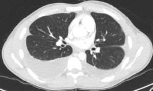 TAC de tórax mostrando derrame pleural bilateral y ausencia de afección pulmonar.