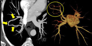 A) TC torácica con reconstrucción de proyección de máxima intensidad (MIP) en la que se identifica una estructura vascular tubular que comunica 2 venas pulmonares. B) TC torácica con reconstrucción de volume rendering (VR) en la que únicamente se visualizan las venas pulmonares y la aurícula izquierda, objetivándose la conexión entre las venas pulmonares derechas correspondiente a la variz venosa pulmonar.