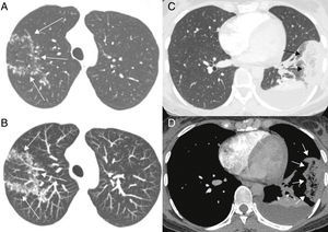(A, B) Mujer de 32 años con embolia pulmonar aguda e infarto pulmonar. Imágenes transversales de TC con contraste en ventanas pulmonar (A) y mediastínica (B) muestran un signo de halo invertido subpleural ovalado en el segmento lateral del lóbulo inferior izquierdo del pulmón (flechas). Se destaca la reticulación dentro del halo. También es visible una atelectasia posterior, que se delinea en un derrame pleural. La paciente tenía coágulos afectando varias arterias pulmonares segmentarias y no segmentarias (no mostrado). (C, D) Una mujer de 39 años con tuberculosis pulmonar activa. Imagen axial de tomografía computarizada del lóbulo pulmonar superior derecho (C) muestra un signo del halo invertido con paredes nodulares. Imagen axial retocada con proyección de máxima intensidad (D) muestra los nódulos en mayor detalle (flechas).