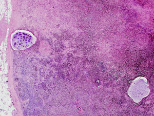 Biopsia de un ganglio paratraqueal inferior derecho, obtenida mediante linfadenectomía, demuestra la presencia de un pigmento antracótico en los macrófagos y de dos fragmentos de cartílago en su interior (Hematoxilina-Eosina ×10).