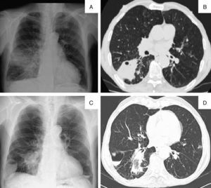 A) Radiografía de tórax inicial en proyección posteroanterior (PA): opacidad heterogénea en el pulmón derecho asociada a un patrón micronodular. B) Tomografía computarizada torácica inicial en plano axial (axial plane [AP]): consolidación en el segmento apical del lóbulo inferior derecho con cavitación inicial. C) Radiografía de tórax en proyección PA: opacidad triangular y nueva lesión cavitaria con nivel hidroaéreo, que ocupaba el ángulo costofrénico derecho. D) Tomografía computarizada torácica en AP: consolidación con cavitación en el segmento apical del lóbulo inferior derecho y formación quística con nivel hidroaéreo, compatible con neumatocele.