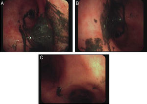 A y B. Bronquios seqmentarios lóbulo superior derecho e izquierdo. C. Carina traqueal tras instilacion y aspiracion repetida de suero.