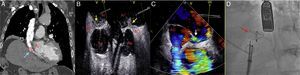 A. TC de tórax con contraste: compresión de la aurícula derecha por la elevación del hemidiafragma ipsilateral (flecha azul). B y C. Ecocardiograma transesofágico: cortocircuito derecha-izquierda a través del foramen oval (paso de contraste a la aurícula izquierda –flecha amarilla–, doppler color –flecha blanca–). D. Implante de dispositivo Amplatzer® (flecha roja). AD: aurícula derecha; AI: aurícula izquierda; Ao: aorta ascendente; VCI: vena cava inferior.