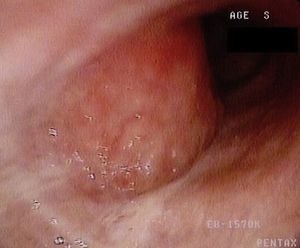 La fibrobroncoscopia óptica mostró una lesión neoplásica hipervascularizada en la pared traqueal posterior.