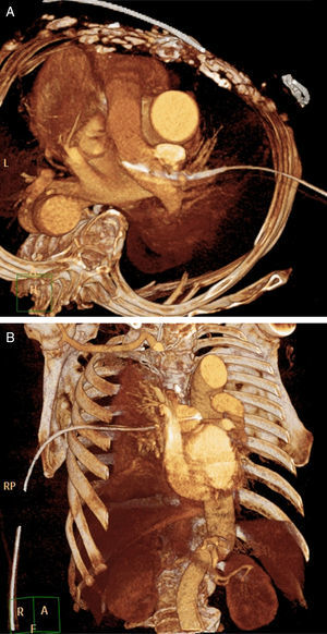 Reconstrucción de la TAC que muestra el drenaje torácico que atraviesa la arteria pulmonar derecha hasta situarse en el interior de la arteria pulmonar principal. A. Plano axial. B. Plano coronal.