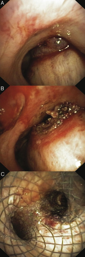 A y B) Obstrucción endoluminal de la vía aérea desde la carina traqueal y el bronquio principal derecho, por un carcinoma escamoso que causaba una compresión anteroposterior de la pars membranacea. C) Tras la inserción del stent en Y, se mantuvo la permeabilidad de la carina traqueal y el bronquio principal derecho.
